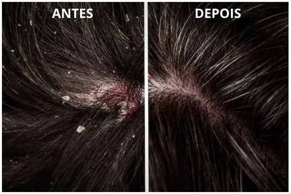 Antes e depois da terapia capilar para couro cabeludo com problemas capilares